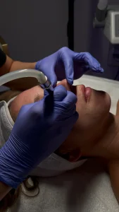 Microneedling treatment being performed on client’s face at Parie Med Spa
