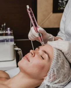 Microneedling treatment being performed on client’s forehead